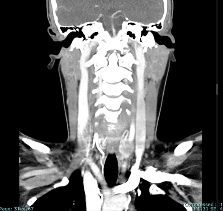 Coronal C+ portal venous phase