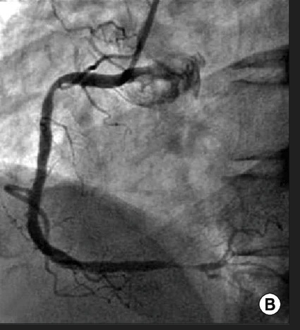 (B) The proximal and distal spasms of the right coronary artery are improved by repeated intracoronary injection of nitroglycerine.