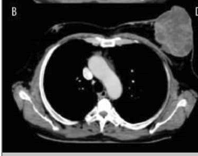Enhanced CT: heterogeneous, necrotic mas with skin thickening
