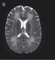 T2 MRI: Supratentorial white matter hyperintensities.