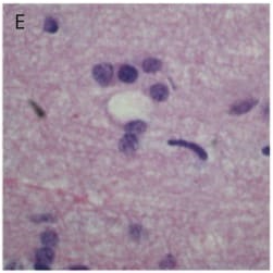 H&E ×400: Vacuolization & microglial activation.