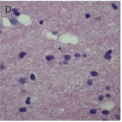H&E ×200: White matter vacuoles & astrogliosis.