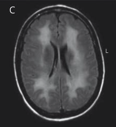 T2-FLAIR MRI: Periventricular white matter hyperintensities sparing U-fibers.