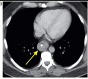 CT scans showed thickening of the distal esophagus.