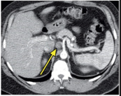 an enlarged lymph node in the region of the gastrohepatic ligament, extending to the celiac axis.