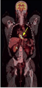 The distal esophagus was intensely FDG avid Pet scanning (SUV 6.2).