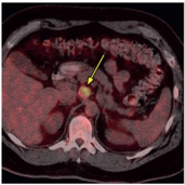The lymph node was also intensely FDG avid (SUV 8.3)