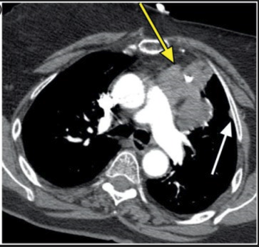CT scan demonstrated a lobulated, left-sided anterior mediastinal mass (yellow arrow) and a 1-cm left-sided pleural nodule (white arrow).