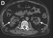 Abdominal CT – white arrows indicate CKD renal changes.