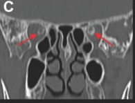 Coronal CT – red arrows mark optic nerve sheath calcifications.