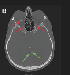 CT (bone window) – red arrows highlight optic sheath calcifications; green arrows show normal brain tissue.