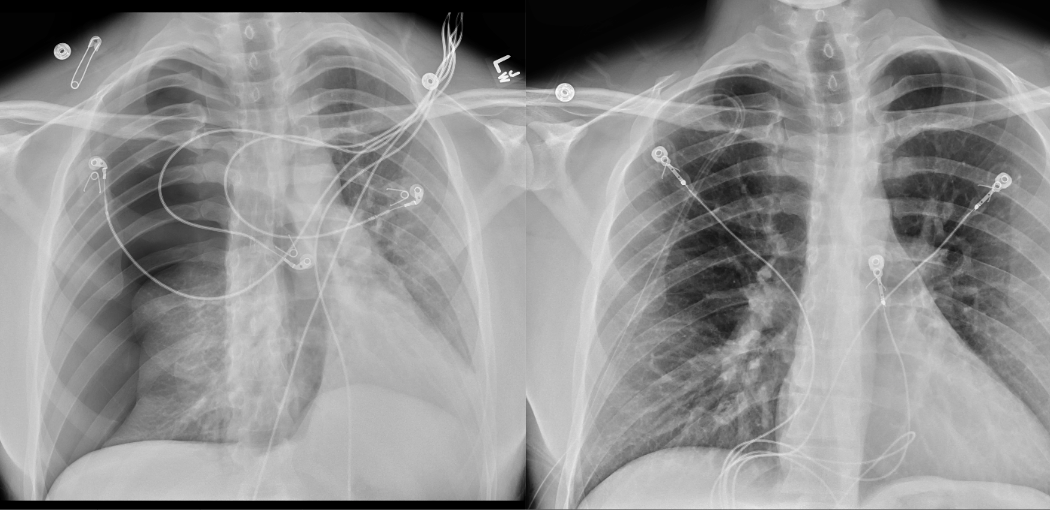 Xray chest