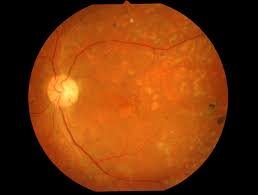 eye