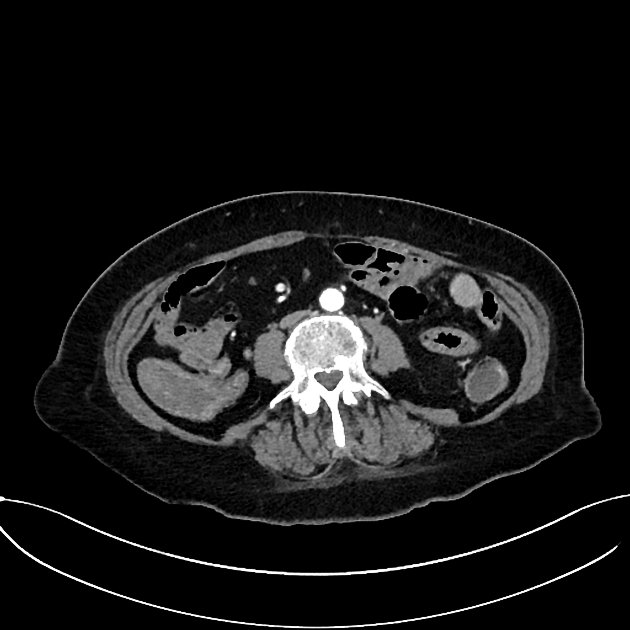 Axial C+ arterial phase