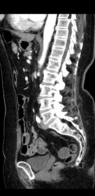 Sagittal C+ arterial phase